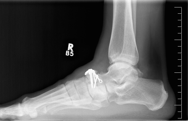 Navicular Fracture ORIF